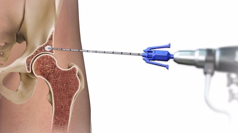injection into hip joint