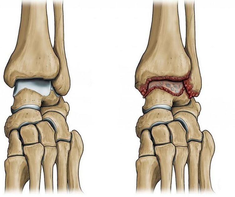 ankle osteoarthritis