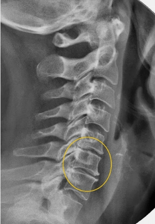 Fiber of the cervical spine on a x -ray