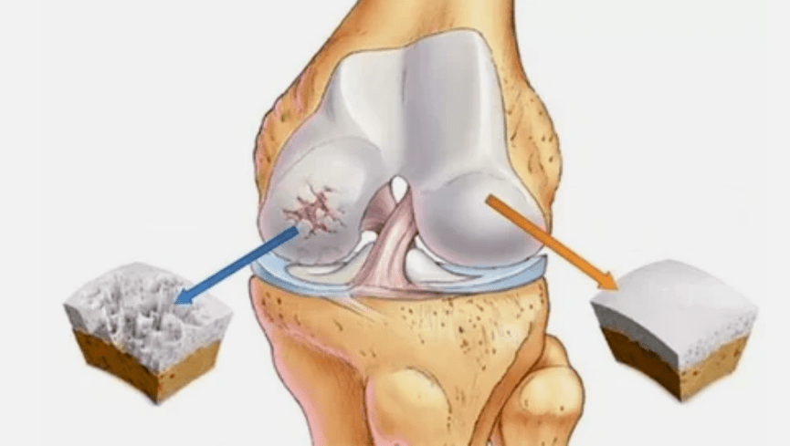 How Arthrosis develops