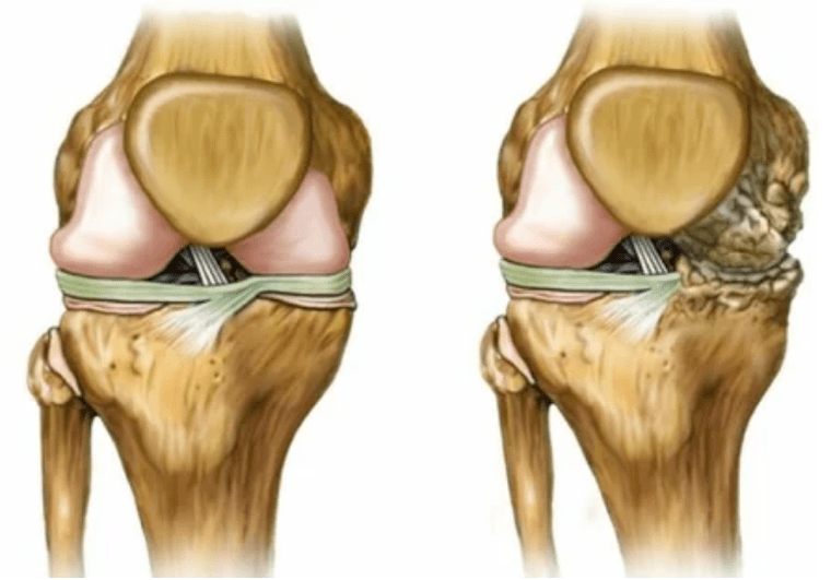 The stage of muscle disease