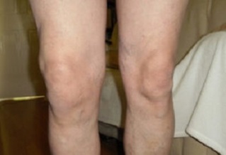 manifestations of arthritis of the knee joint (1)