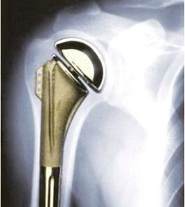 Shoulder replacement for arthritis