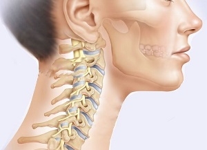 What are the symptoms of cervical bone necrosis