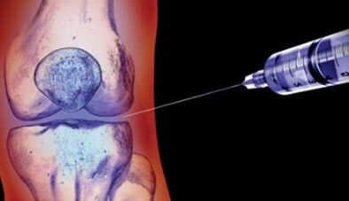 Treatment methods for osteoarthritis
