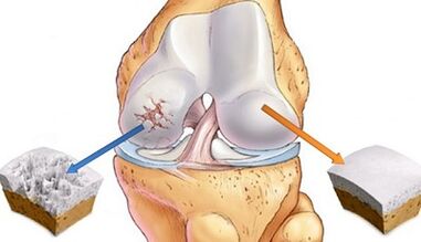 cause of arthritis