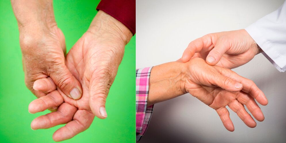 Swelling and pain are the first signs of hand arthritis