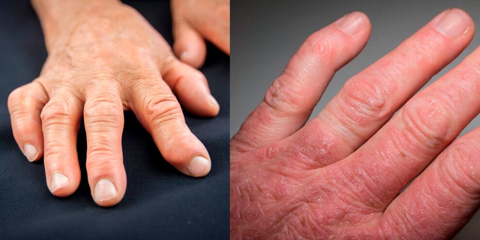 rheumatism and psoriatic arthritis of the hands
