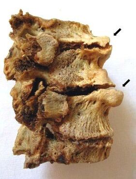 The part of the vertebra affected by osteonecrosis