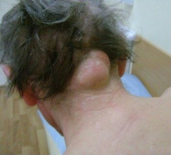 Cancer as a cause of neck pain