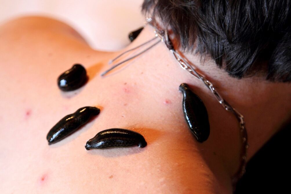 Leeches treat cervical spondylosis