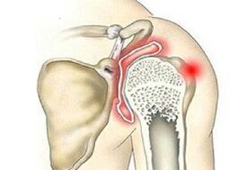 destruction of the shoulder joint with paresis