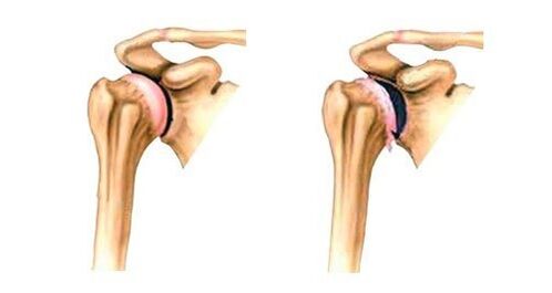 healthy shoulder joints and joints