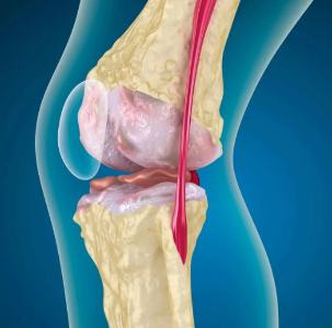 The knee Osteoarthritis