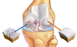 the knee osteoarthritis